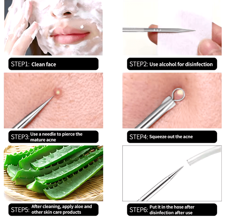 🔪 Acne Needle Set – 4pcs Double-Ended Stainless Steel Tool for Blackhead & Blemish Removal 🔪 Acne Needle Set – 4pcs Double-Ended Stainless Steel Tool for Blackhead & Blemish Removal