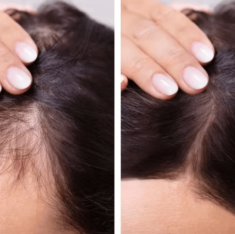 Hair Growth Serum – Anti Hair Loss Treatment for Faster Hair Regrowth – Strengthens Roots & Repairs Damaged Hair – Alopecia Support Formula