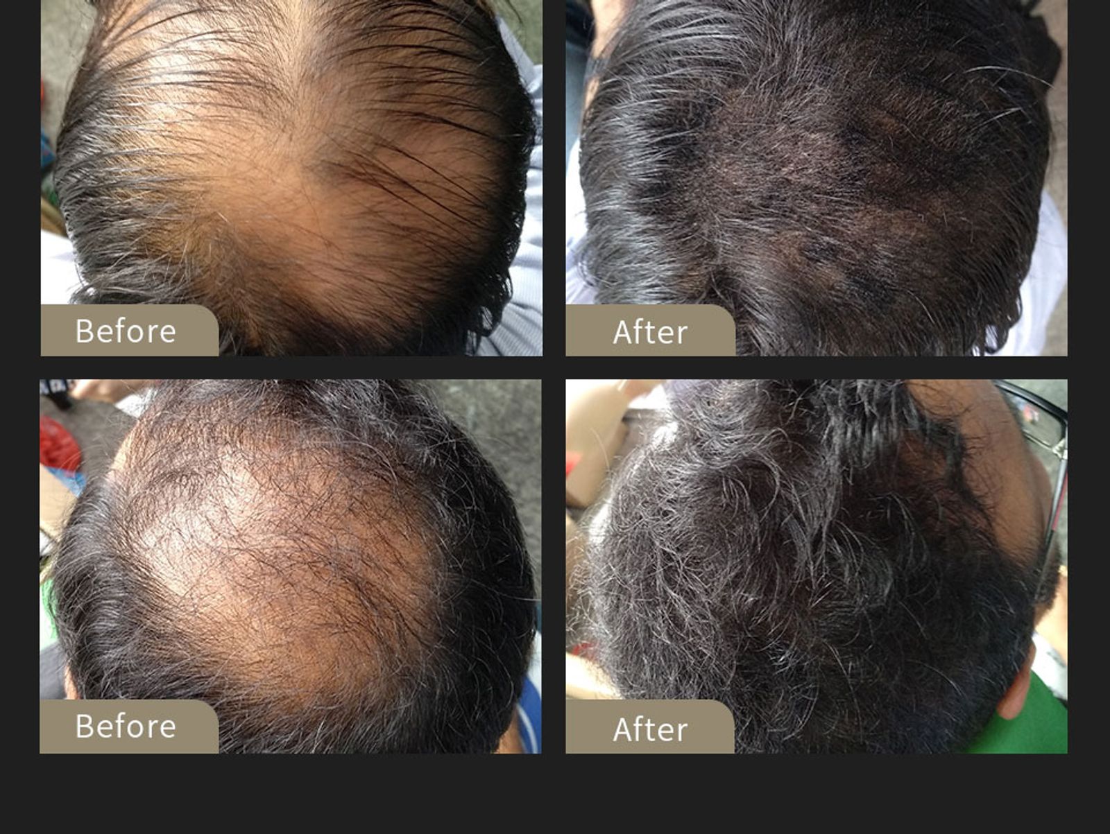 SEVICH Hair Building Fiber Set for Hair Loss Treatment